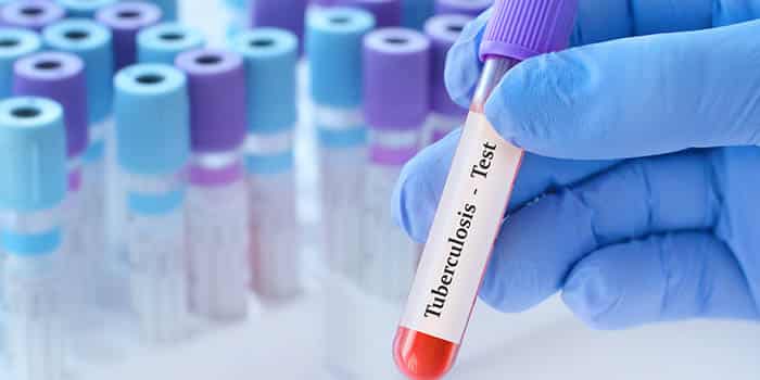 California Casino Warns Visitors After Community Member Tests Positive for Tuberculosis